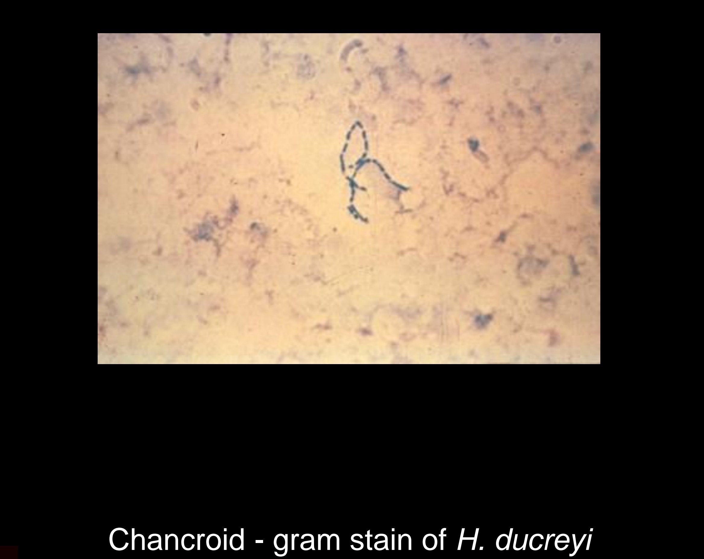 Chancroid ulcer on female labia showing painful ragged lesion with surrounding inflammation and edema documented at STD Nepal